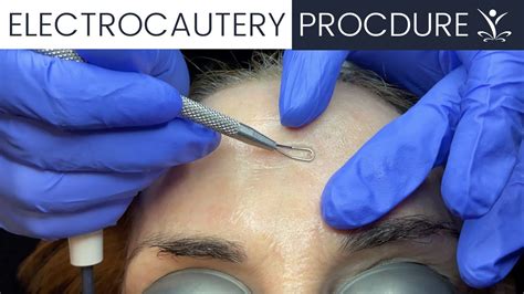 Like us on Facebook to be updated about our services and discounts! https://www. . Electrocautery for sebaceous hyperplasia aftercare